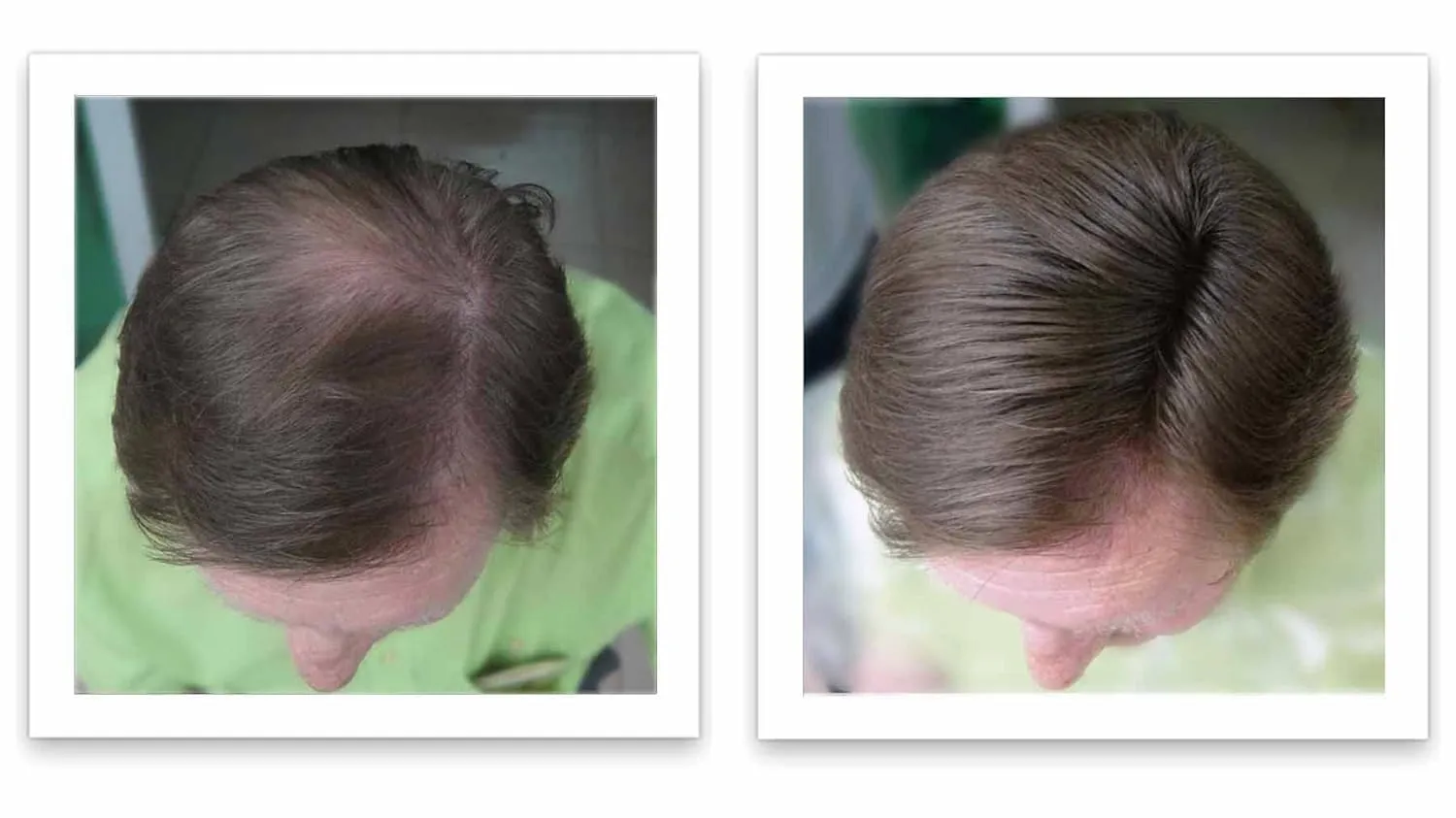 Caboki All-Natural, Plant-Based Hair Building Fiber. Hair Loss Concealer. Covers Bald Spot and Thinning Hair. (16G, 40-Day Supply) (Medium Brown)