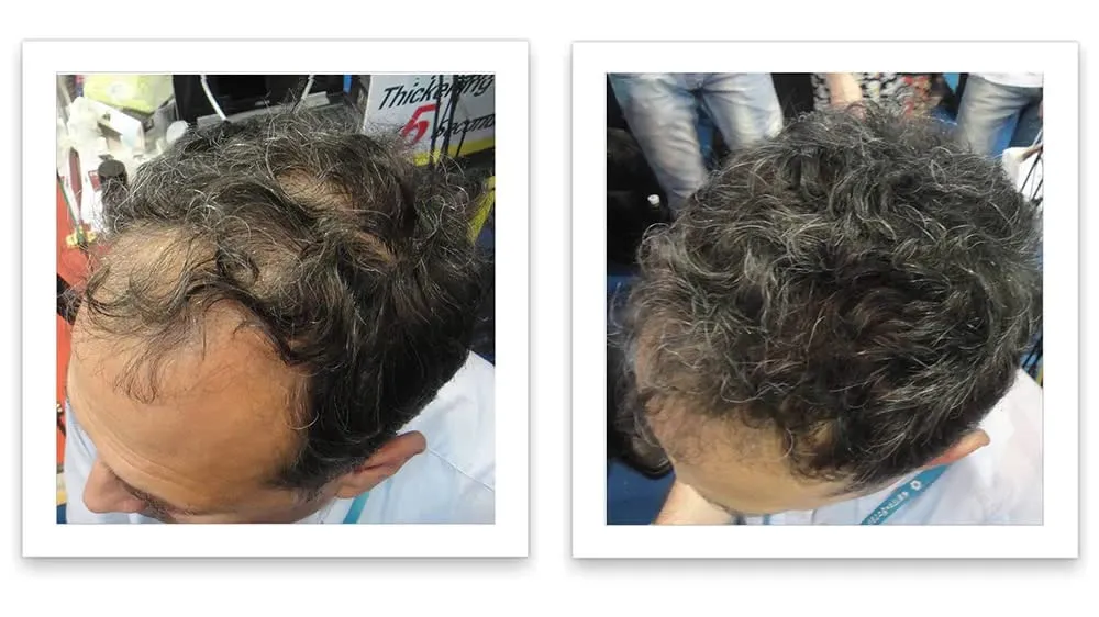 Caboki Hair Loss Concealer. All-Natural Hair Building Fiber. Make Thin Hair Look 10X Fuller Instantly. Eliminate the Appearance of Bald Spot and Thinning Hair (30G, 90-Day Supply). Salt & Pepper-Dark