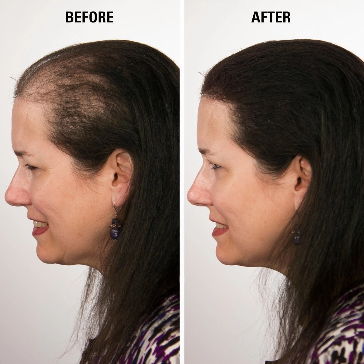 ECLIPSE Hair Fibers Auburn for Thinning Hair for Women & Men to Conceal Hair Loss in 15 Seconds - 100% Undetectable Hair Building Fibers, 15g