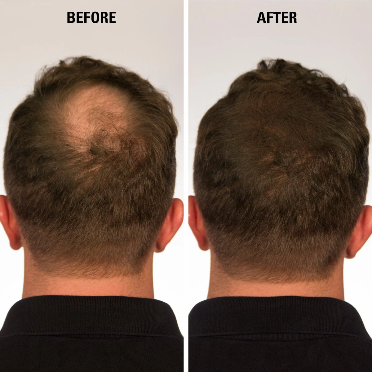 Hair Fibers Black for Thinning Hair for Women & Men - 100% Undetectable Hair Building Fiber Powder - Conceal Hair Loss in 15 Seconds, 30g
